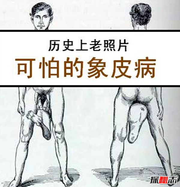 惊人!象皮病是什么病?象皮病可以治愈吗(慢性人体寄生虫病)